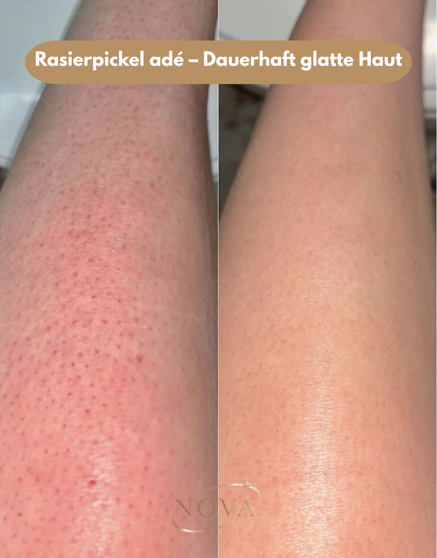 NOVA IPL Haarentferner