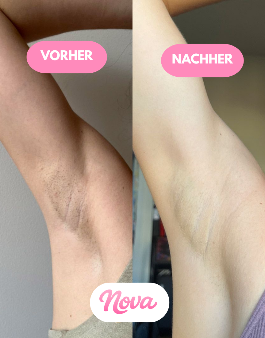 NOVA IPL Haarentferner