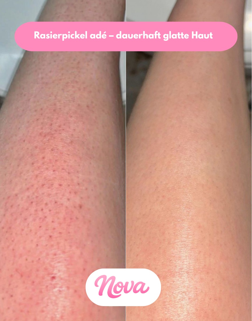 NOVA IPL Haarentferner