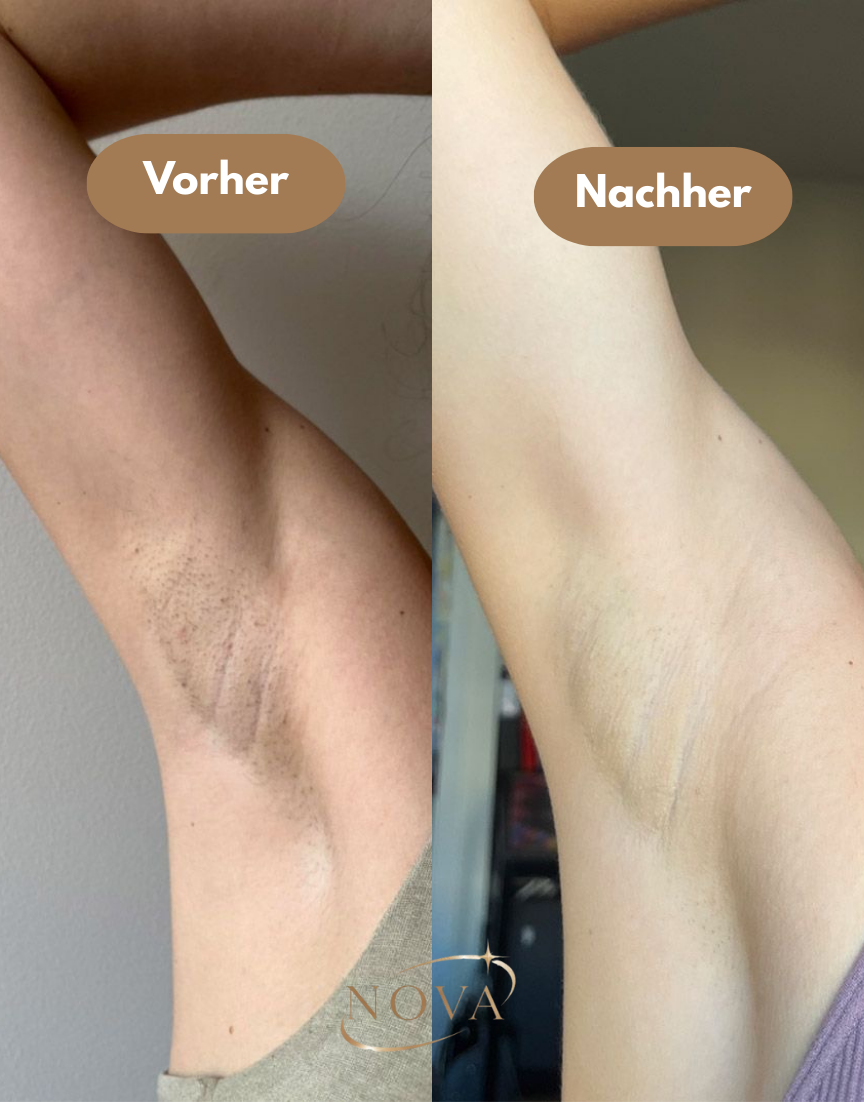 Nova IPL Haarentferner