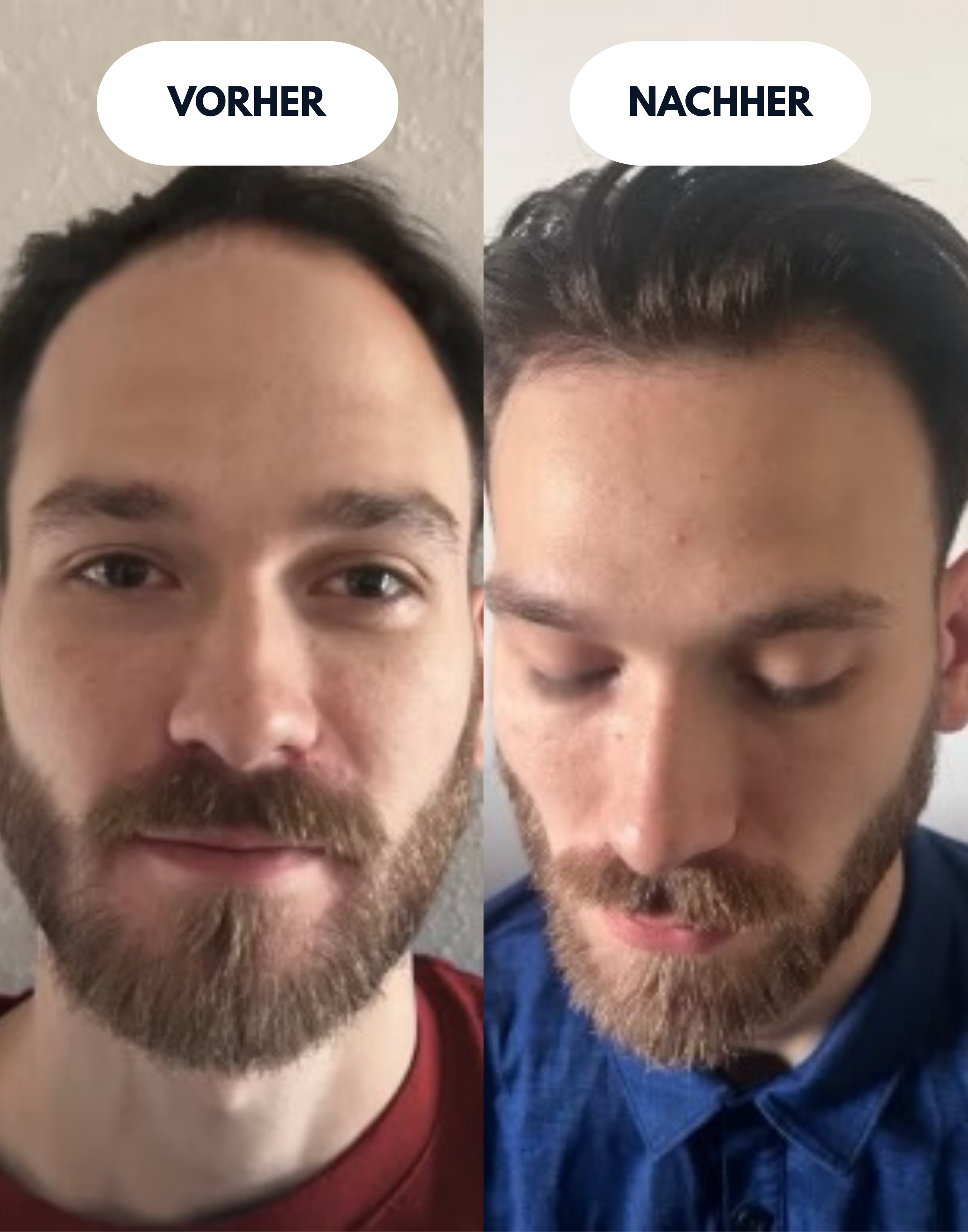 NOVA Hair Regenerator Pro