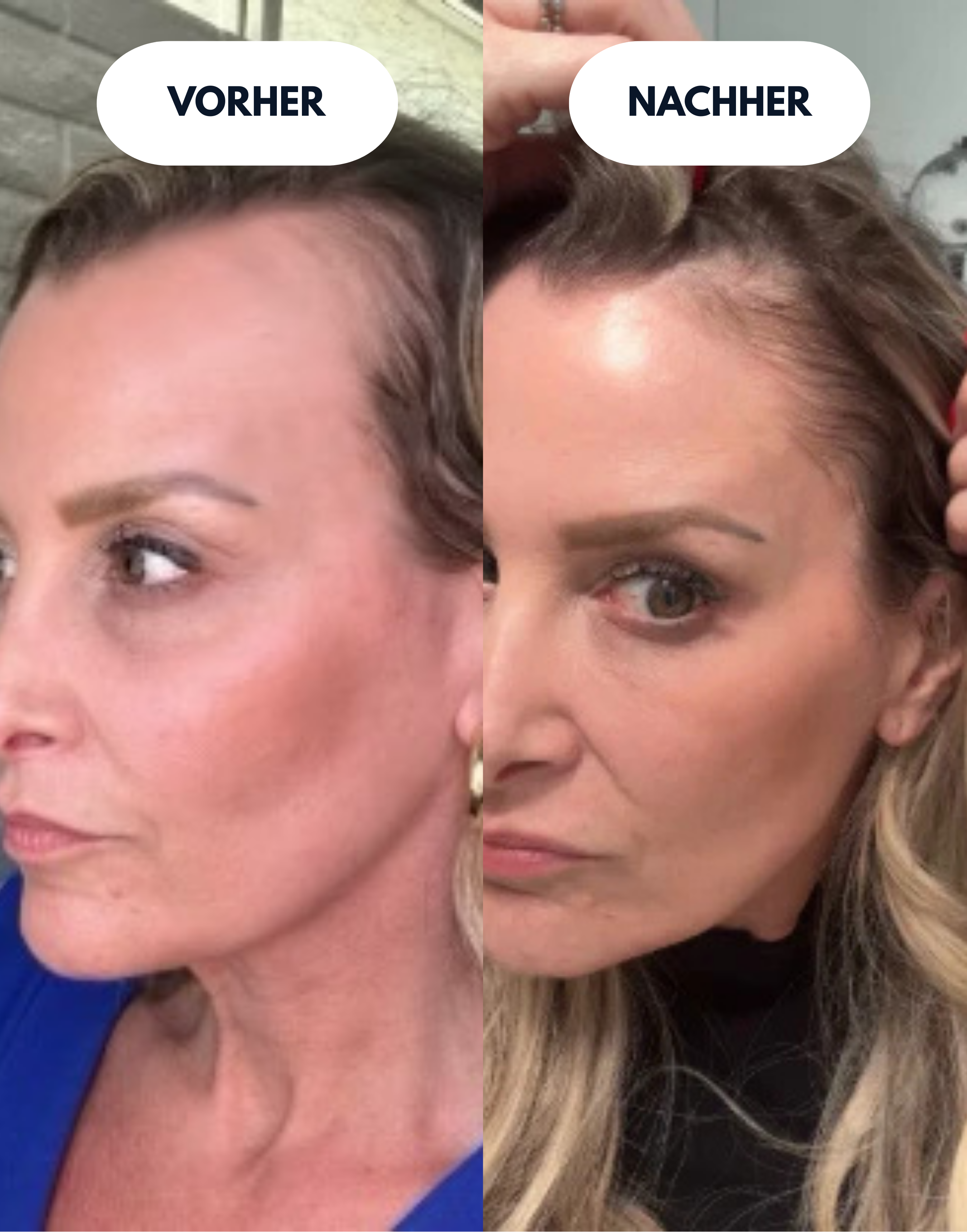 NOVA Hair Regenerator Pro